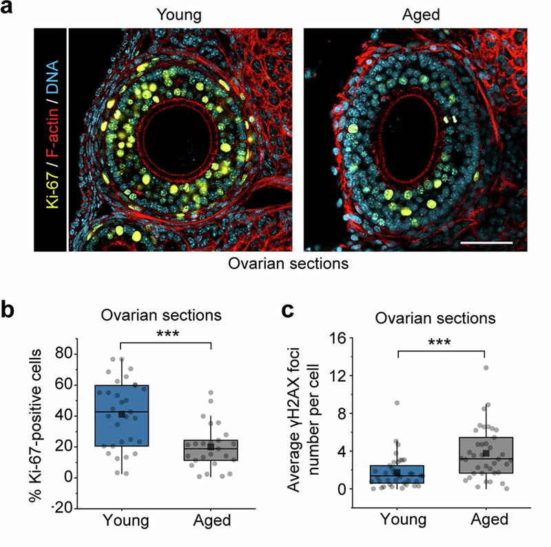 卵泡積累與年齡相關(guān)的異常 卵泡積累與年齡相關(guān)的異常