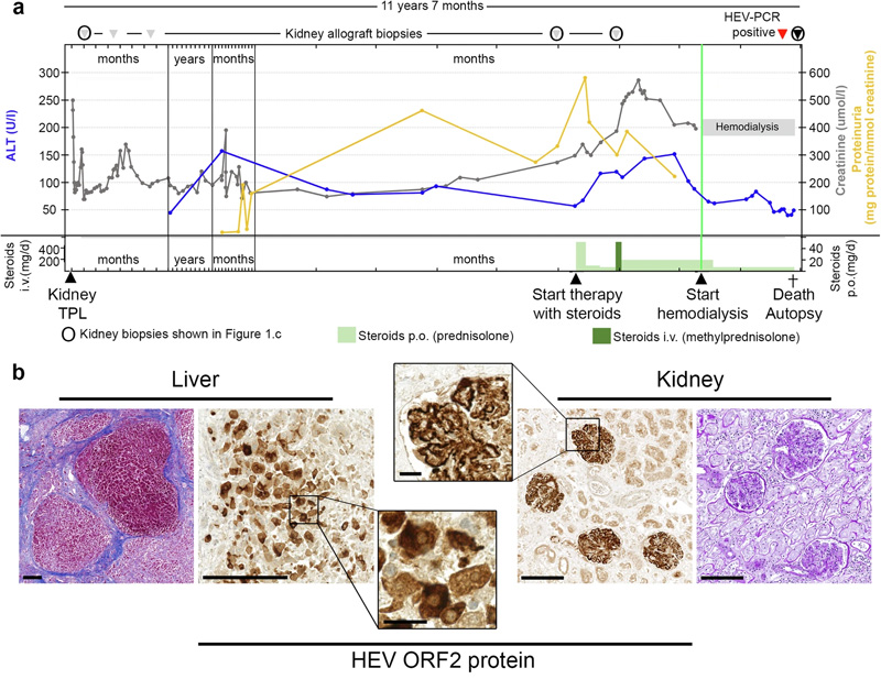 
戊型肝炎腎移植受者膜增殖型免疫復(fù)合物腎小球腎炎的臨床過(guò)程、尸檢結(jié)果和逐漸發(fā)展