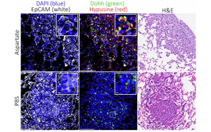 Nature：癌癥轉(zhuǎn)移時為何青睞肺部？