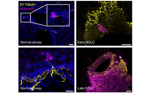 癌細胞會放電？Nature揭示小細胞肺癌擴散新機制