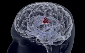 PNAS：將侵襲性癌細胞重新編程為無害的癌細胞