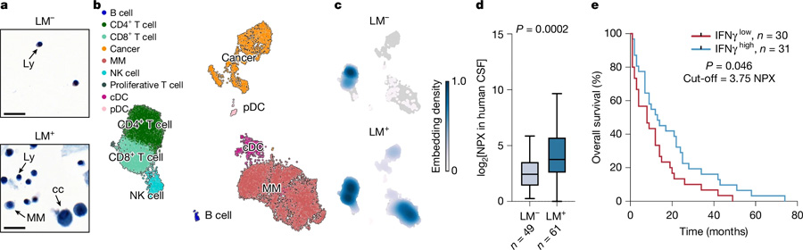炎癥誘導(dǎo)的腦脊液細(xì)胞增多見于軟腦膜轉(zhuǎn)移患者 炎癥誘導(dǎo)的腦脊液細(xì)胞增多見于軟腦膜轉(zhuǎn)移患者