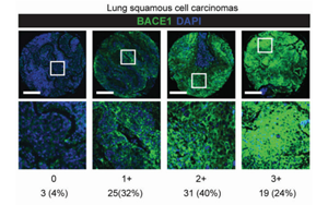 CRISPR激活篩選揭示BACE1驅動非小細胞肺癌腦轉移的機制及治療潛力