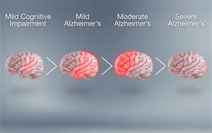 基因-代謝組-飲食互作在癡呆風險中的精準預防：APOE4純合子特異性代謝通路與地中海飲食的調(diào)控作用