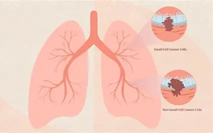 DNA甲基化與基因組改變協(xié)同驅(qū)動(dòng)非小細(xì)胞肺癌演化的機(jī)制研究