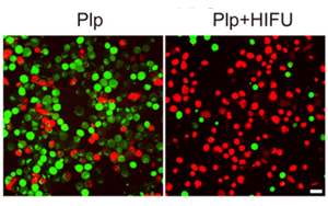 HIFU驅(qū)動(dòng)靶向細(xì)胞焦亡治療基底樣乳腺癌：從基因篩選到血小板膜雜交脂質(zhì)體的協(xié)同機(jī)制探索