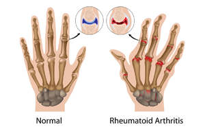 中性粒細(xì)胞與白蛋白比率（NPAR）：類風(fēng)濕關(guān)節(jié)炎骨質(zhì)疏松風(fēng)險(xiǎn)的新型預(yù)測(cè)因子及其臨床轉(zhuǎn)化價(jià)值