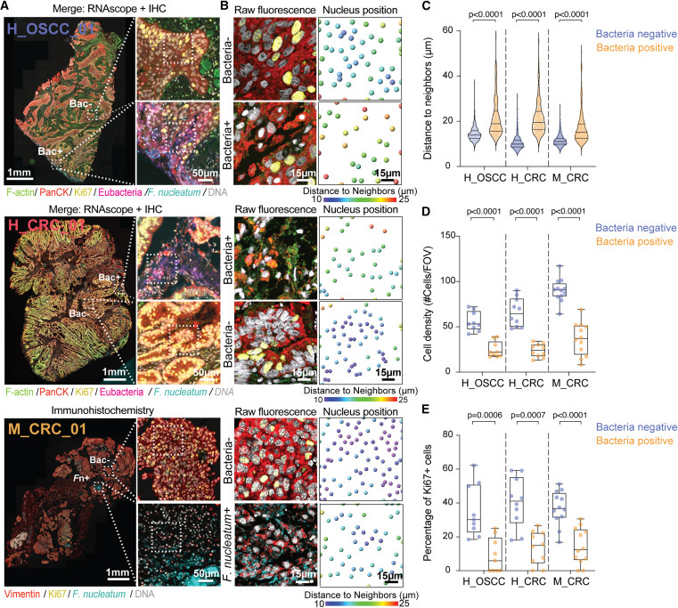 細菌感染微灶內(nèi)癌細胞的空間分布