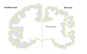 阿爾茨海默病中Tau蛋白病理對腦溝深度的特異性影響及其與海馬功能連接的關(guān)聯(lián)研究