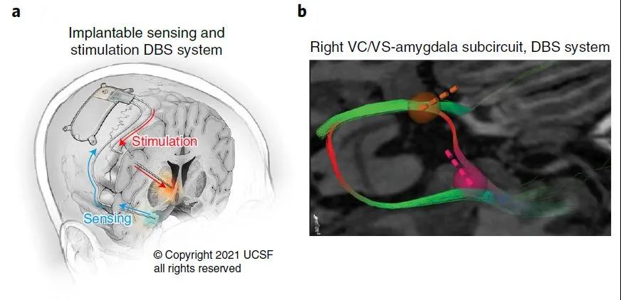 腦電刺激成功拯救重度抑郁癥患者，治愈抑郁癥時代離我們不遠了？