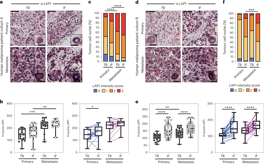 LAP1水平在人類黑色素瘤進(jìn)展中增加 LAP1水平在人類黑色素瘤進(jìn)展中增加