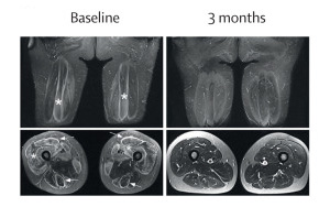 《柳葉刀》：首次成功利用CAR-T細(xì)胞治療嚴(yán)重肌肉炎癥