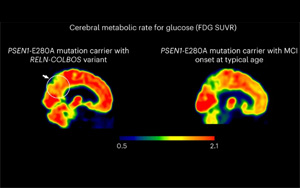 Nature Medicine發(fā)現(xiàn)了新的基因變異，可以預防阿爾茨海默病