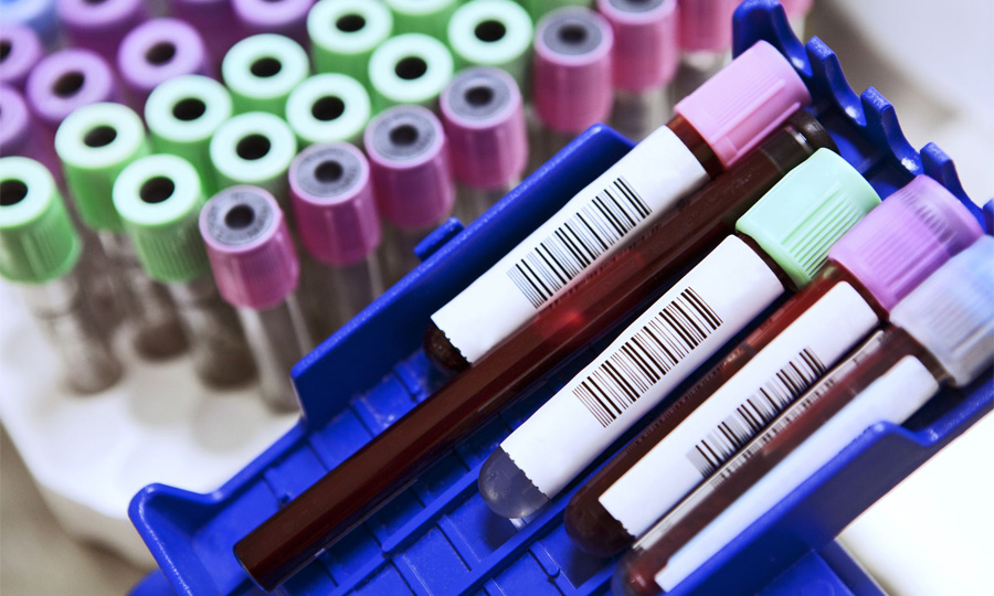 乳酸脫氫酶(LD/LDH)檢測(cè) 乳酸脫氫酶(LD/LDH)檢測(cè)