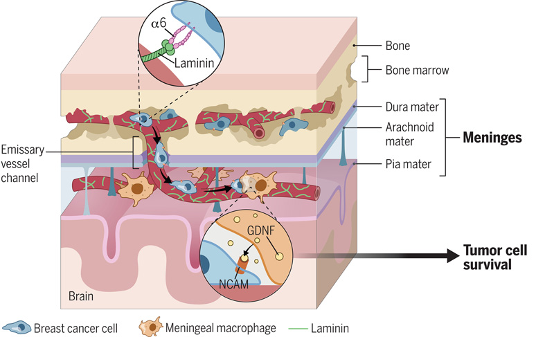 乳腺癌細(xì)胞轉(zhuǎn)移和在腦脊膜的促生交互